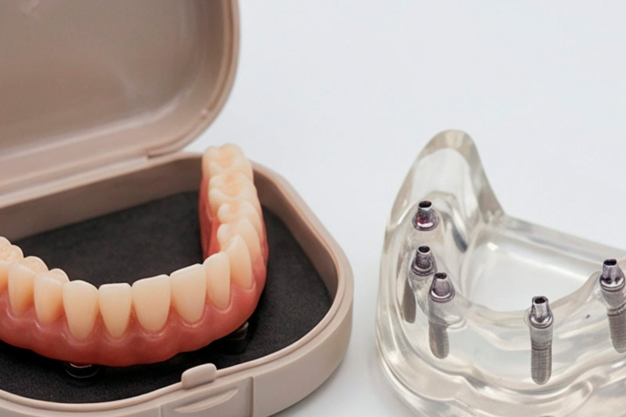 ¿Cuánto dura un implante dental? Todo lo que necesitas saber.